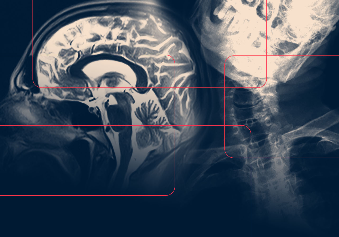 Arnold-Chiari Syndrome